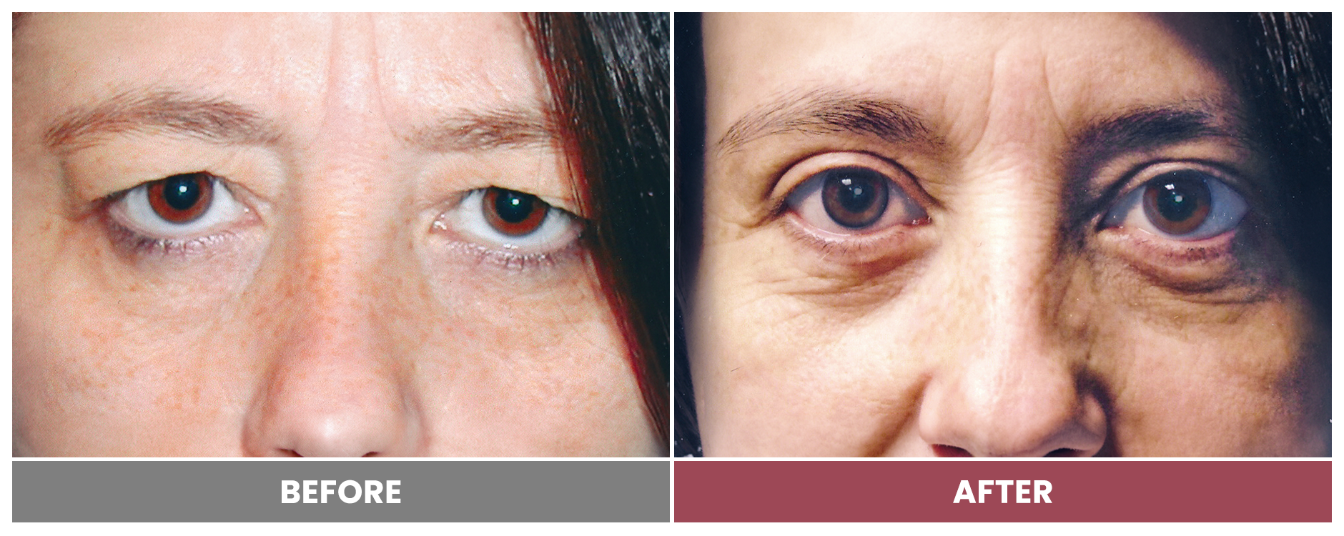 Upper Blepharoplasty - Case 9